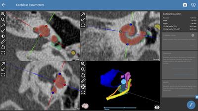 Robotic Cochlear Implant Surgery: Imaging-Based Evaluation of Feasibility in Clinical Routine